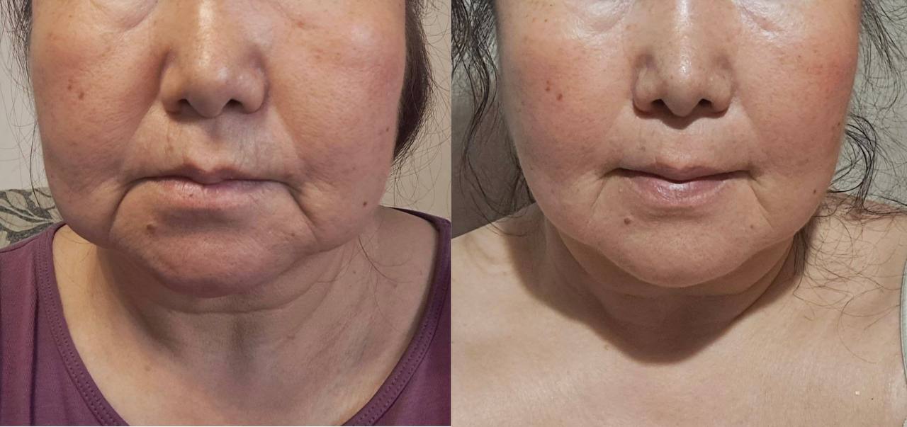 Student lower-face before-and-after result