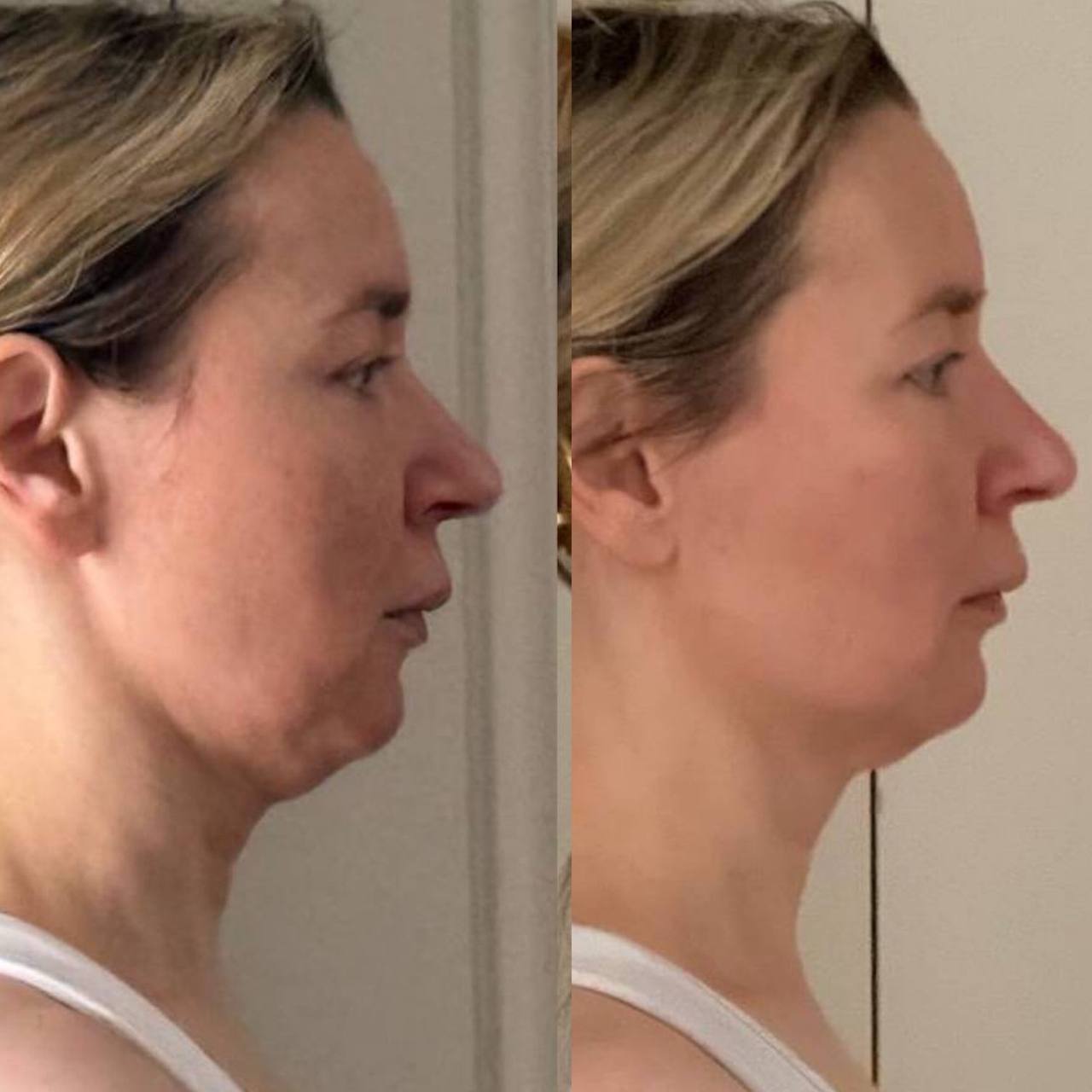 Student side-profile before-and-after result